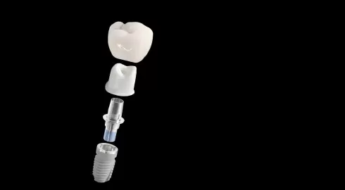 Diş implantlarının üstüne kron kaç türlü yapabiliriz ?