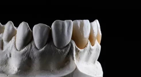Diş Kaplaması (diş kronları)
