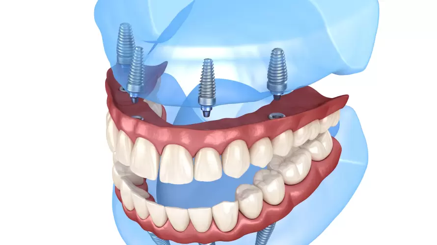 Ağızda hiç diş yoksa implant yapılır mı? 